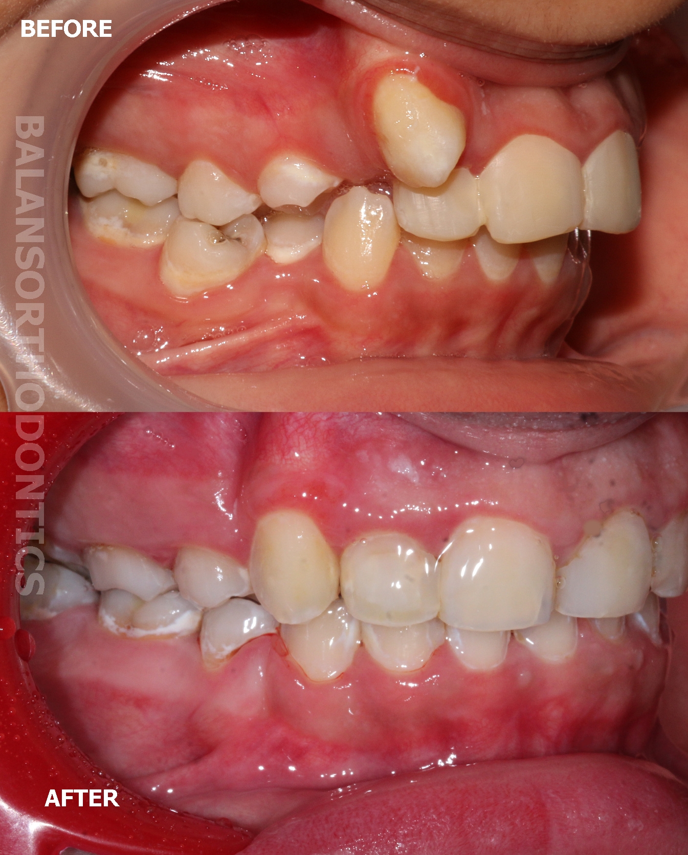 Treatment 11