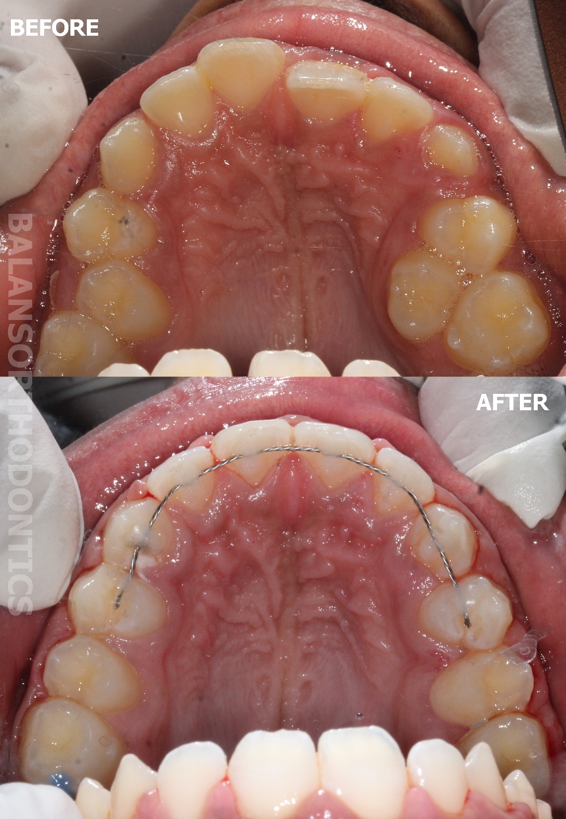 Treatment 13