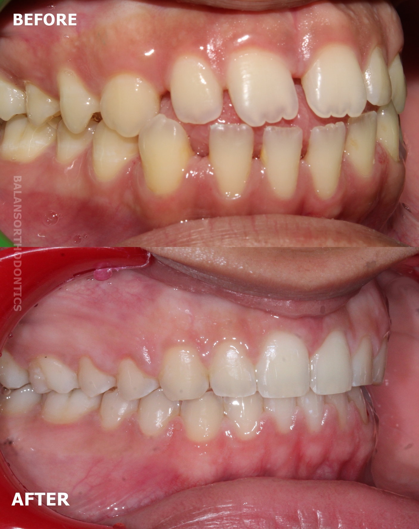 Treatment 14