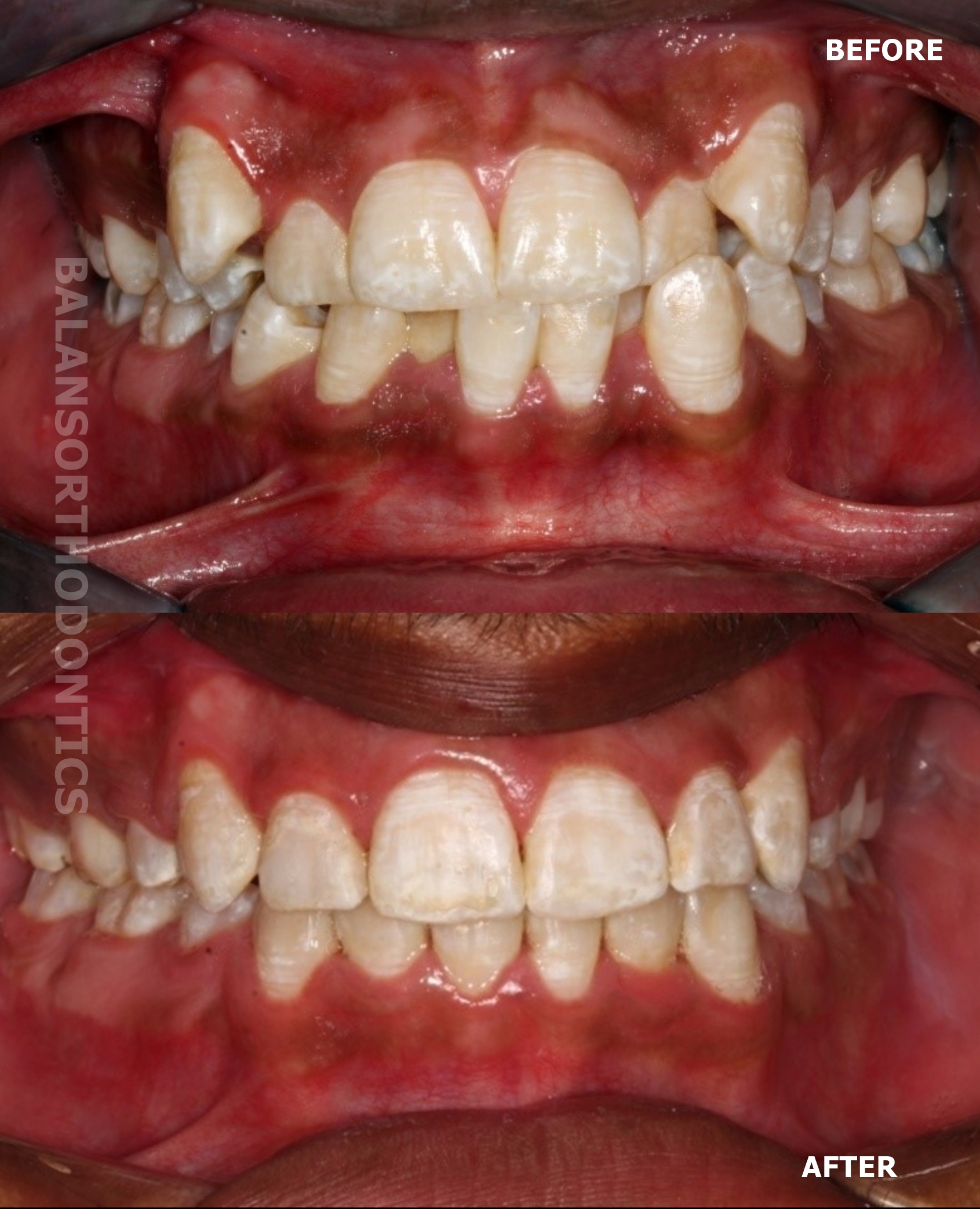 Treatment 18